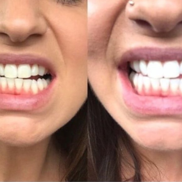 Teeth Whitening Kit (3 Kits) - Picture 7 of 8